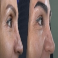 کاشت مو و ابرو با پرداخت 8 تومن و قسطی